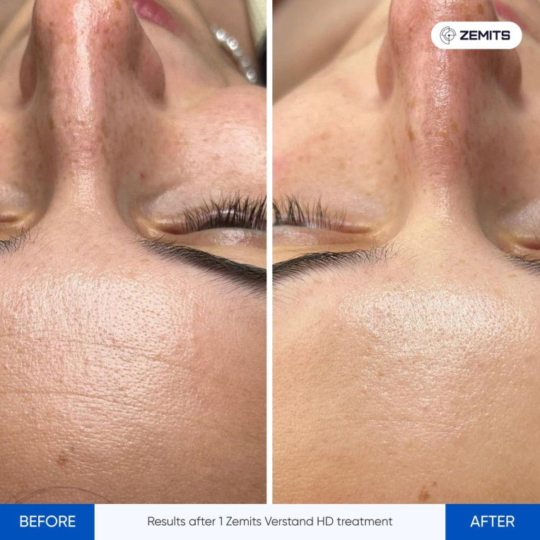 facial-before-and-after